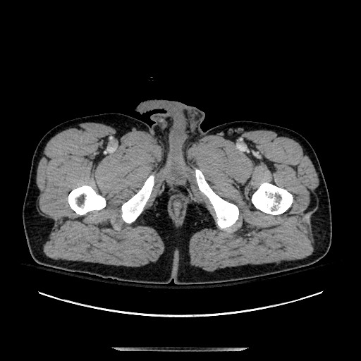 Blunt abdominal trauma with solid organ and musculoskelatal injury with active extravasation (Radiopaedia 68364-77895 A 172).jpg