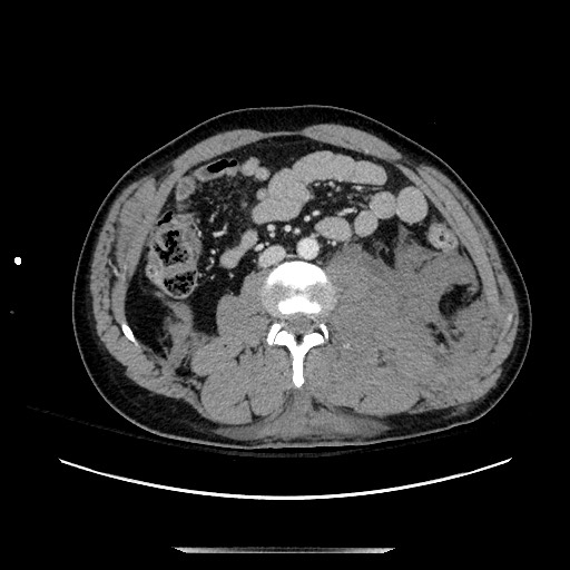 Blunt abdominal trauma with solid organ and musculoskelatal injury with active extravasation (Radiopaedia 68364-77895 A 78).jpg