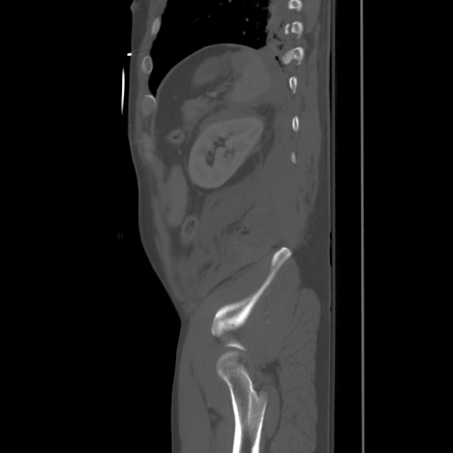 Blunt abdominal trauma with solid organ and musculoskelatal injury with active extravasation (Radiopaedia 68364-77895 Sagittal bone window 90).jpg