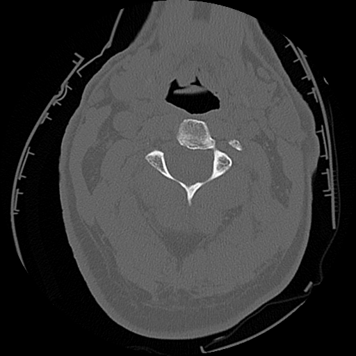 File:Blunt cerebrovascular injury (Radiopaedia 53682-59743 Axial bone window 21).png