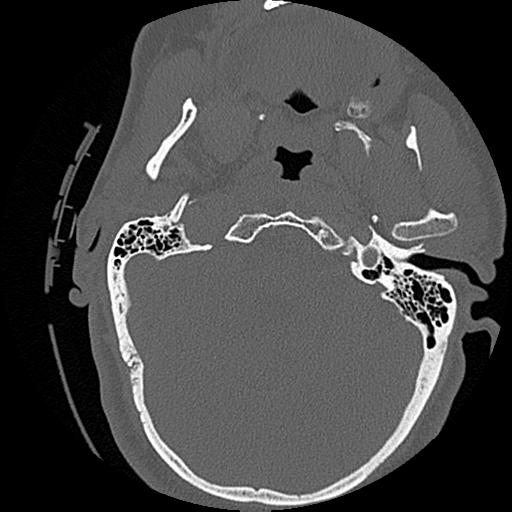 File:Blunt cerebrovascular injury (Radiopaedia 53682-59743 Axial bone window 8).png