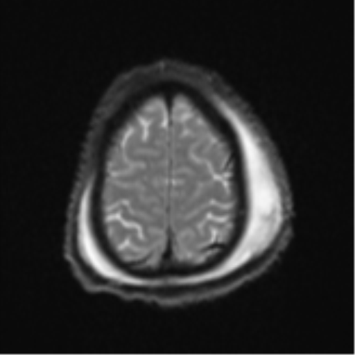 Blunt cerebrovascular injury (Radiopaedia 53682-59745 Axial DWI 26).png