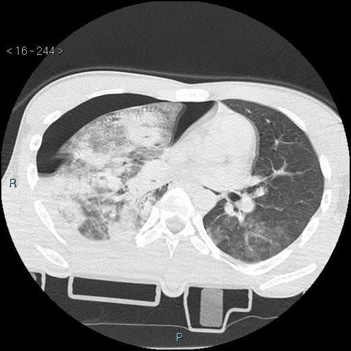 Blunt chest trauma (Swiss cheese sign) (Radiopaedia 38519-40618 Axial lung window 36).jpg