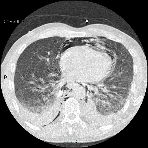 File:Boerhaave syndrome (Radiopaedia 27683-27897 lung window 60).jpg