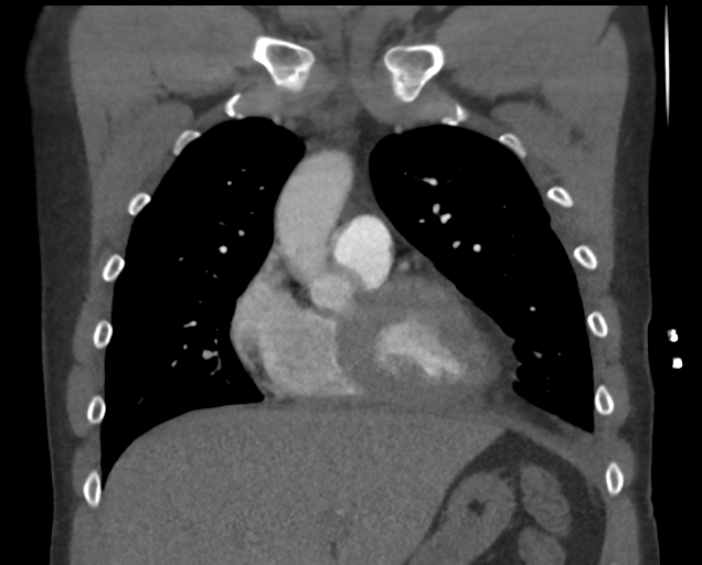 File:Boerhaave syndrome (Radiopaedia 39382-41660 C 31).png