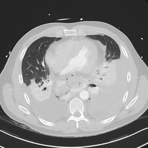 Boerhaave syndrome (Radiopaedia 39382-41661 Axial lung window 35).png