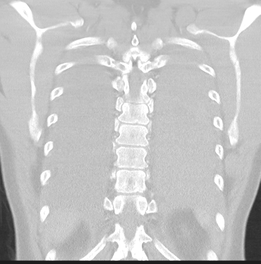 Boerhaave syndrome (Radiopaedia 39382-41661 Coronal lung window 42).png