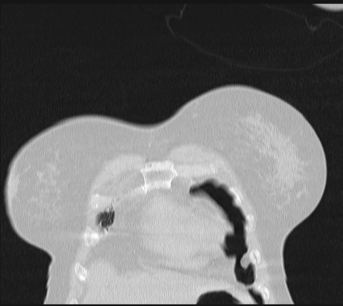 Boerhaave syndrome (Radiopaedia 45644-49799 Coronal lung window 9).jpg