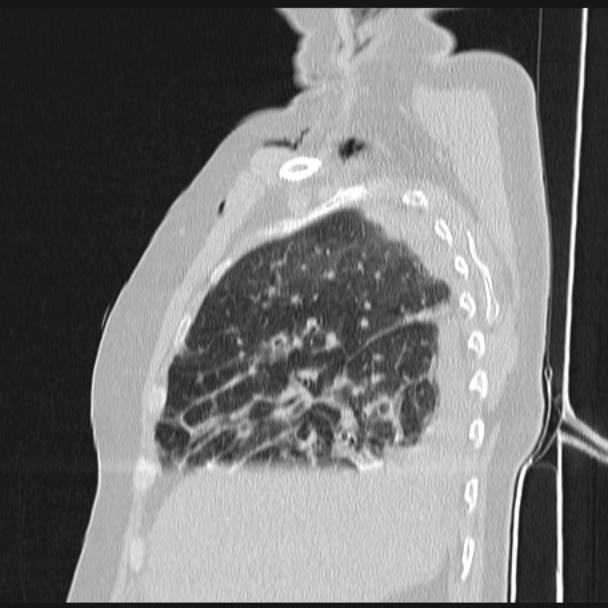 Boerhaave syndrome (Radiopaedia 45644-49799 Sagittal lung window 20).jpg