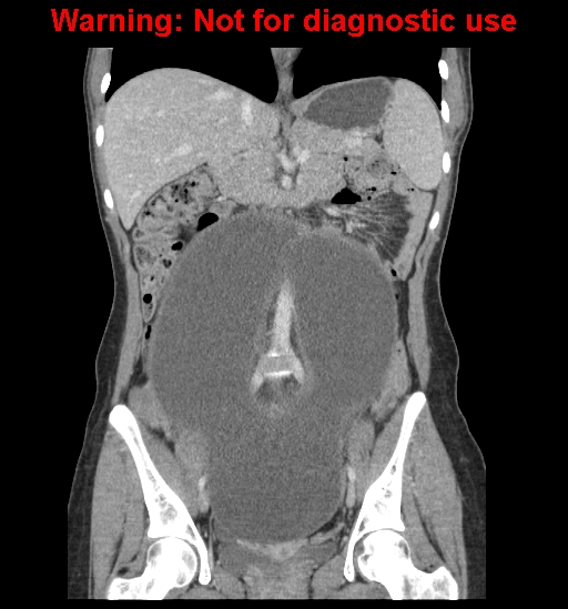Borderline mucinous cystadenoma of ovary (Radiopaedia 25586-25767 B 35).jpg
