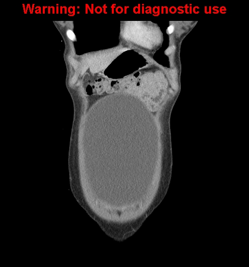 Borderline mucinous cystadenoma of ovary (Radiopaedia 25586-25767 B 6).jpg