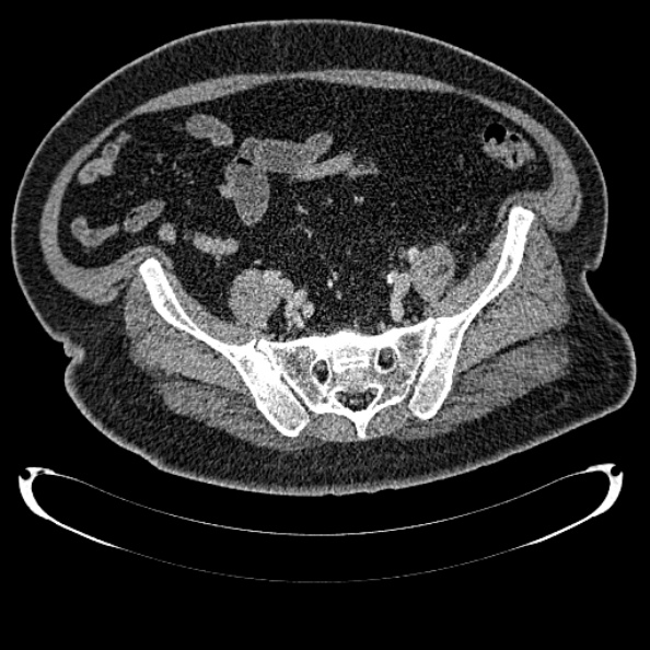 File:Bosniak renal cyst - type IV (Radiopaedia 24244-24518 C 304).jpg