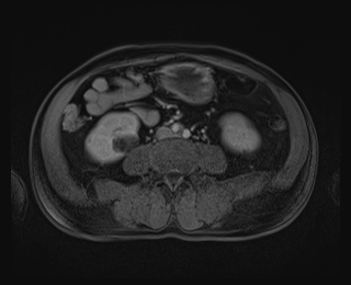 File:Bouveret syndrome (Radiopaedia 61017-68856 Axial T1 C+ fat sat 59).jpg