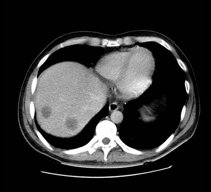 Bowel obstruction from colon carcinoma (Radiopaedia 22995-23028 A 9).jpg