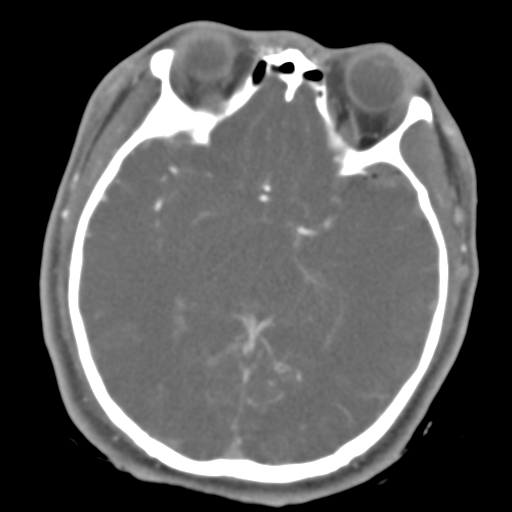 File:Brain contusions, internal carotid artery dissection and base of skull fracture (Radiopaedia 34089-35339 D 30).png