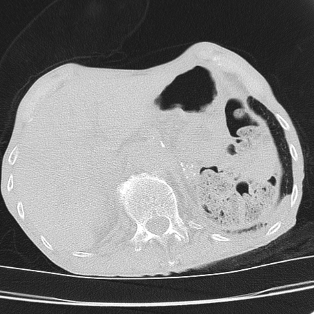Brain metastases from lung cancer (Radiopaedia 27849-28093 Axial lung window 62).jpg