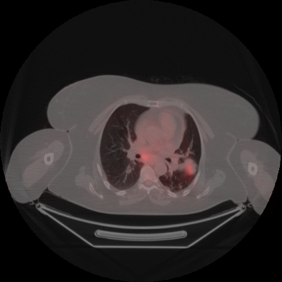 Brain metastasis (Radiopaedia 89847-106962 Axial lung window 27).jpg