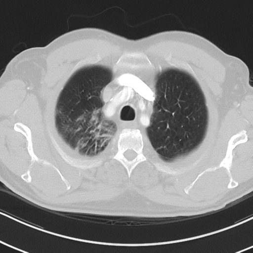 Brain metastasis (large cystic mass) (Radiopaedia 47497-52104 Axial lung window 7).png