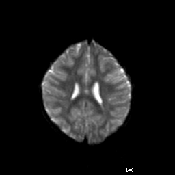 File:Brainstem ganglioglioma (Radiopaedia 10763-11224 Axial DWI 7).jpg