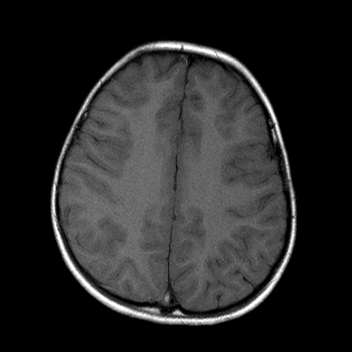 File:Brainstem ganglioglioma (Radiopaedia 10763-11224 Axial T1 6).jpg