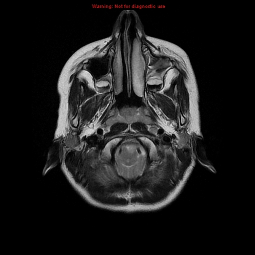 File:Brainstem glioma (Radiopaedia 9444-10124 Axial T2 2).jpg