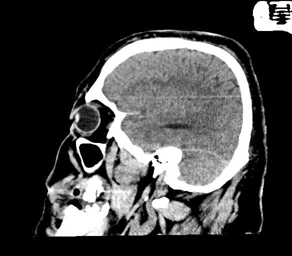 Brainstem hemorrhage (Radiopaedia 81294-94976 C 14).jpg