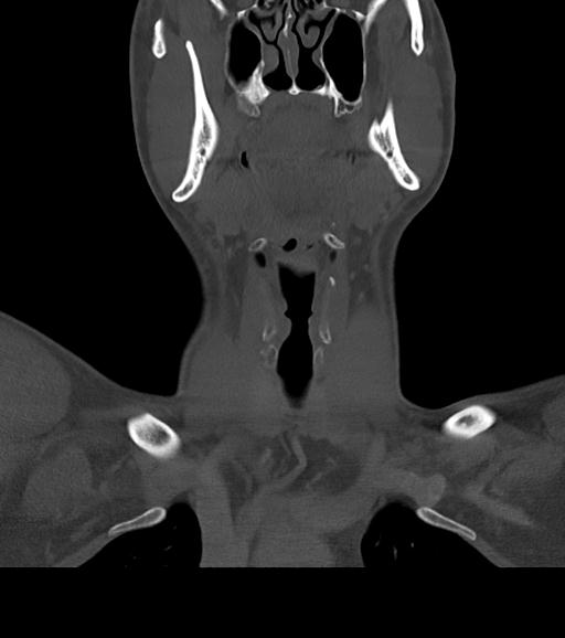 Branchial cleft cyst (Radiopaedia 31167-31875 Coronal bone window 26).jpg