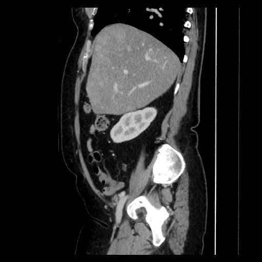 Breast cancer pseudocirrhosis with lobar invovlement (Radiopaedia 81080-94670 D 89).jpg