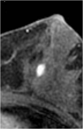 File:Breast fibroadenoma (Radiopaedia 13817-13695 MR Perfusion 6).jpg