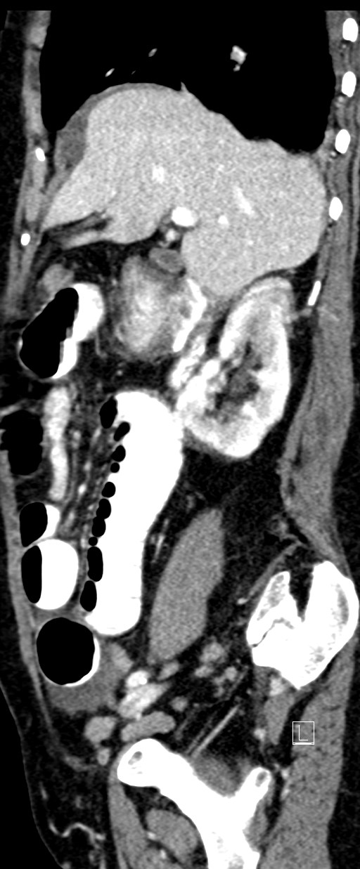 Broad ligament hernia (Radiopaedia 84802-100276 C 56).jpg