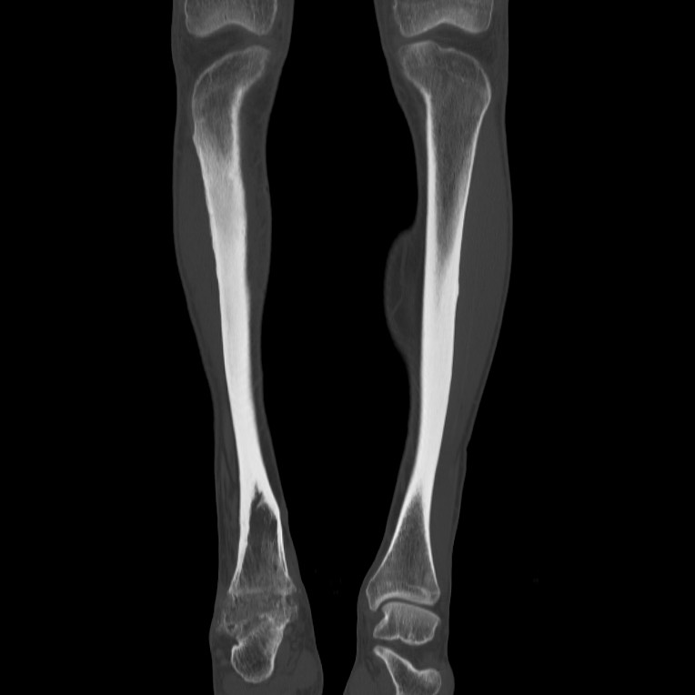 Brodie abscess - tibia (Radiopaedia 66028-75204 Coronal bone window 10).jpg