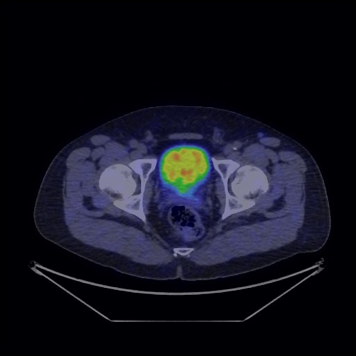 Bronchial carcinoid tumor (Radiopaedia 67377-76765 68Ga-DOTATATE PET-CT 72).jpg