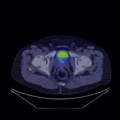 Bronchial carcinoid tumor (Radiopaedia 67377-76765 68Ga-DOTATATE PET-CT 73).jpg