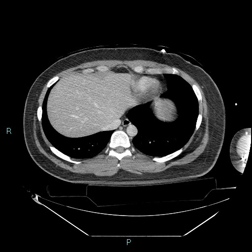 Bronchial carcinoid tumor (Radiopaedia 78272-90870 C 96).jpg