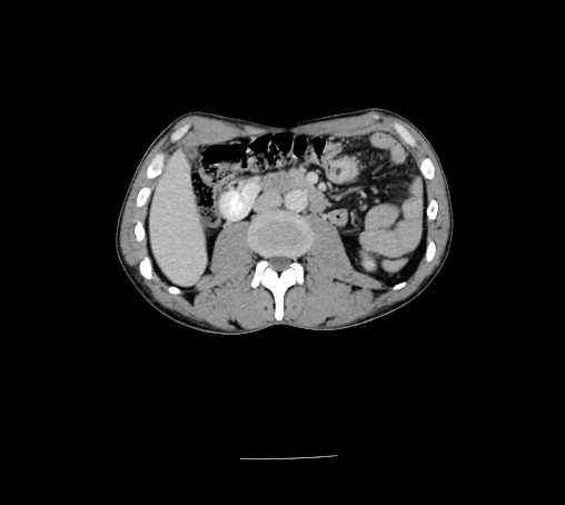 File:Bronchiectasis in Crohn disease (Radiopaedia 60311-67977 B 80).jpg