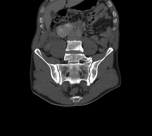 Bronchiectasis in Crohn disease (Radiopaedia 60311-67977 Coronal bone window 29).jpg