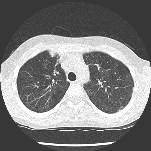 Bronchiolotis obliterans (Radiopaedia 73769-84575 Axial lung window 15).jpg