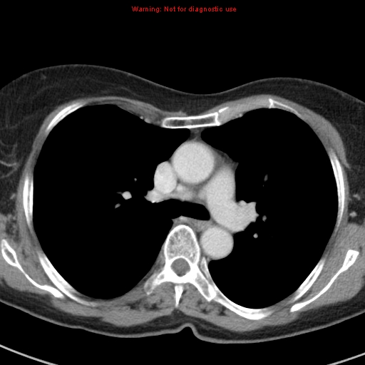 File:Bronchoalveolar carcinoma (BAC) (Radiopaedia 13436-13392 B 22).jpg