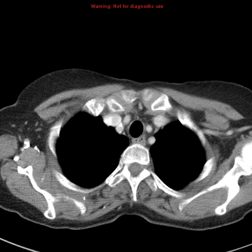 File:Bronchoalveolar carcinoma (BAC) (Radiopaedia 13436-13392 B 8).jpg