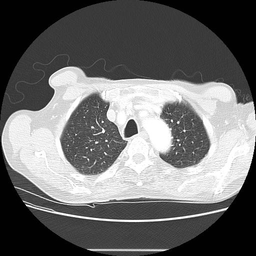Bronchocele (Radiopaedia 17097-16795 Axial lung window 26).jpg