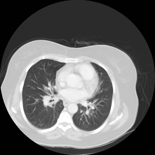 Bronchogenic carcinoma (Radiopaedia 73497-84262 Axial lung window 38).jpg