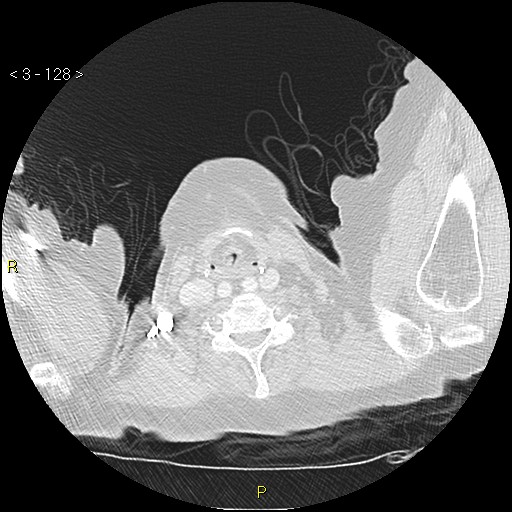 Bronchogenic carcinoma as an incidental finding (Radiopaedia 16453-16130 Axial lung window 128).jpg