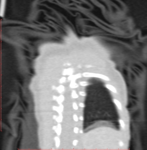 Bronchogenic cyst (Radiopaedia 78599-91409 Coronal lung window 205).jpg