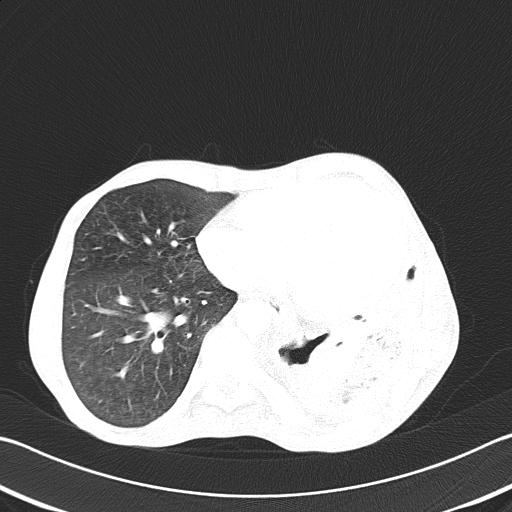 Bronchopleural fistula secondary to tuberculosis (Radiopaedia 20415-20322 Axial lung window 39).jpg