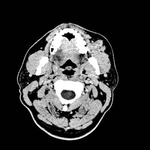 Buccal fat pad arteriovenous malformation (Radiopaedia 70936-81142 Axial non-contrast 20).jpg