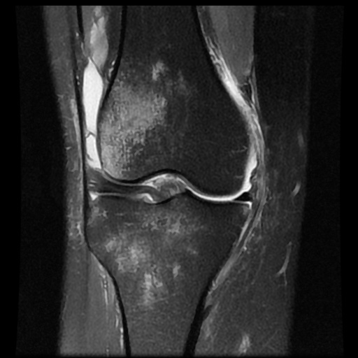 File:Bucket handle meniscus tear (Radiopaedia 56916-63751 Coronal PD fat sat 9).jpg