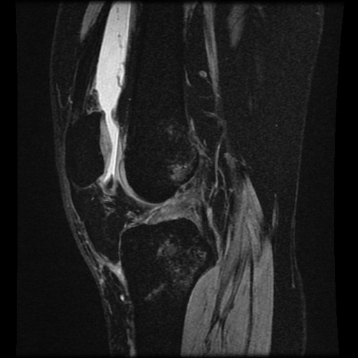 File:Bucket handle meniscus tear (Radiopaedia 56916-63751 H 42).jpg