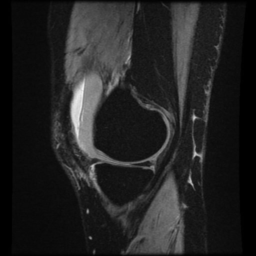 File:Bucket handle meniscus tear (Radiopaedia 56916-63751 H 64).jpg