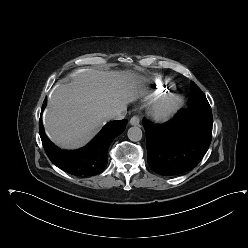 File:Buried bumper syndrome - gastrostomy tube (Radiopaedia 63843-72577 Axial Inject 11).jpg