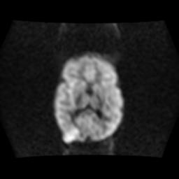 File:Burkitt lymphoma of the orbit- pre and post chemotherapy (Radiopaedia 31214-31929 Axial DWI 9).jpg